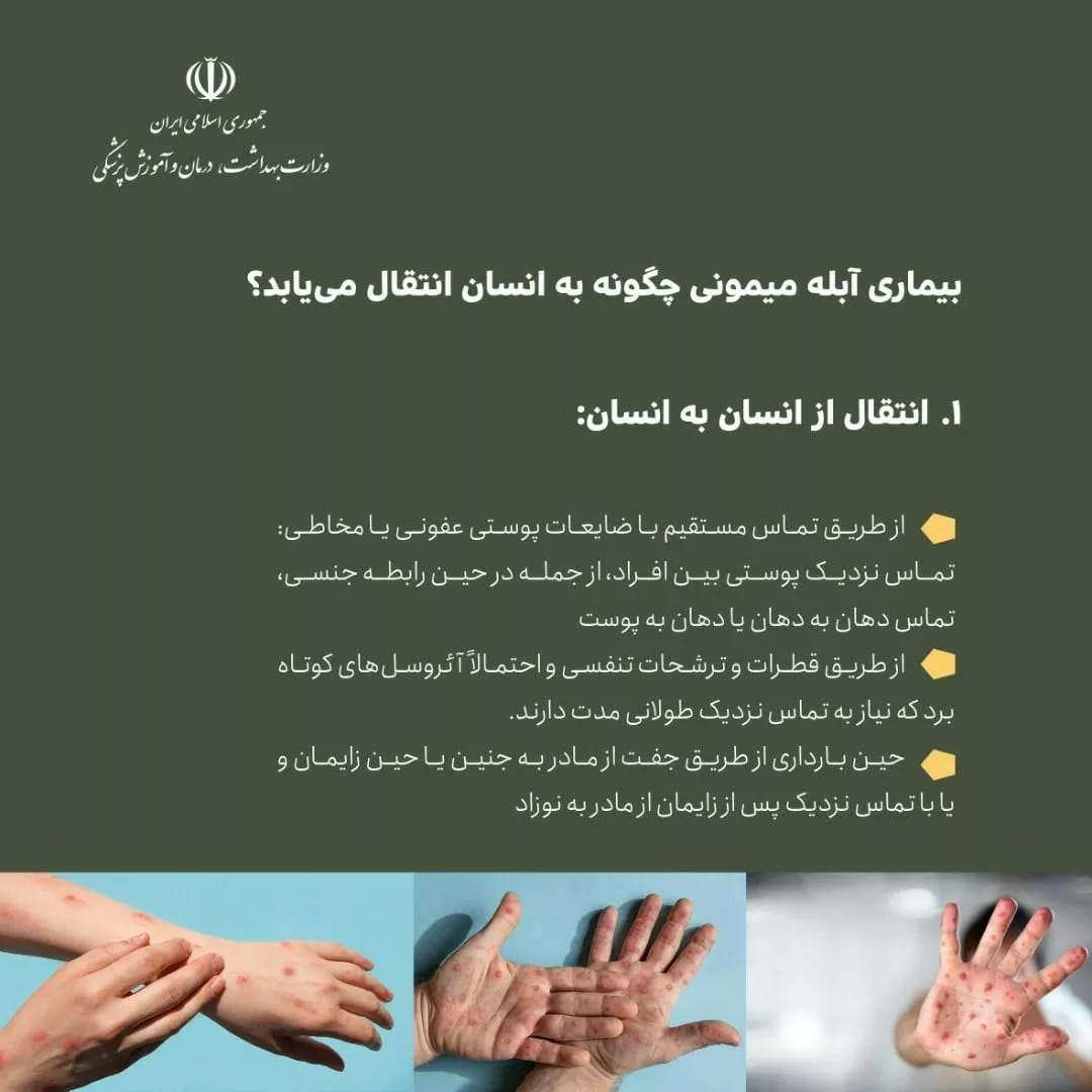 آبله 1